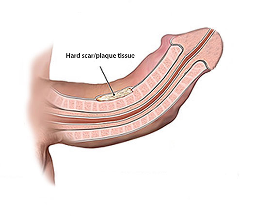 penis straightening with a pump